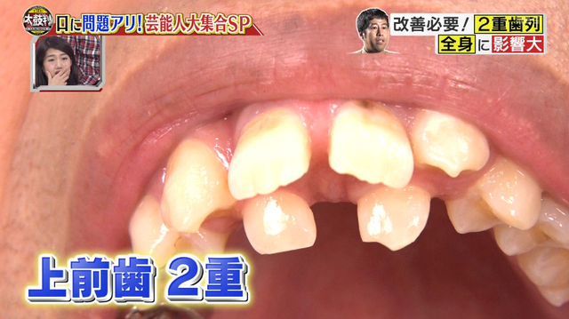 画像 ウエストランド井口浩之の歯並びに驚愕 歯列矯正で現在の歯は アスワカ