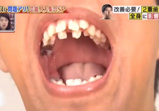 画像 ウエストランド井口浩之の歯並びに驚愕 歯列矯正で現在の歯は アスワカ